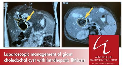 Laparoscopic Management Of Giant Choledochal Cyst With Intrahepatic