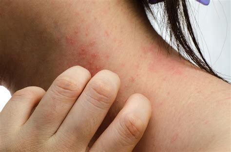 Methotrexate Treatment Improves Symptoms Of Severe Atopic Dermatitis