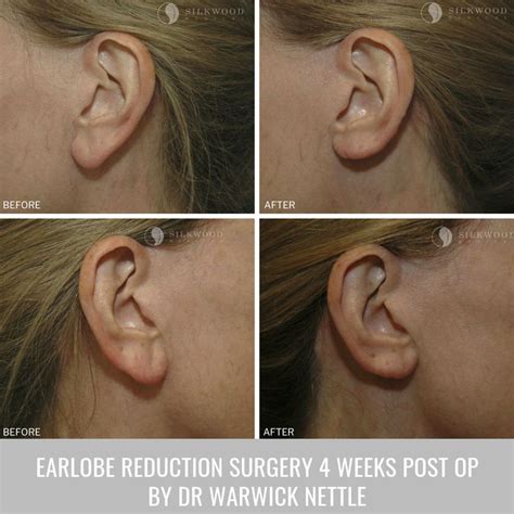 Its All About The Details Earlobe Reduction Surgery Rejuvenated My