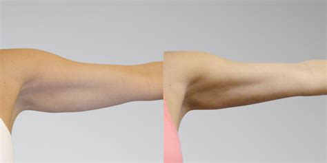 Before And After Arm Liposuction Pictures From Sono Bello