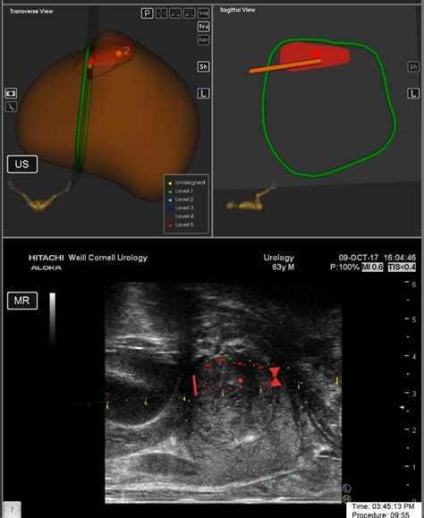 Ideal Stage 2a Experience With In Office Transperineal Mriultrasound