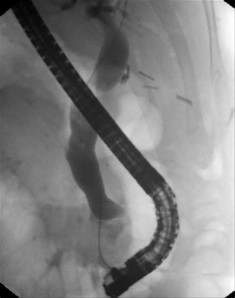 Ercp Demonstrating Dilated Common Bile Duct With Distal Filling Defect