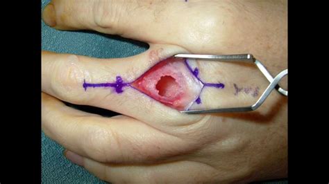 Live Surgery Enchondroma Cartilage Benign Tumor Of The Finger Youtube