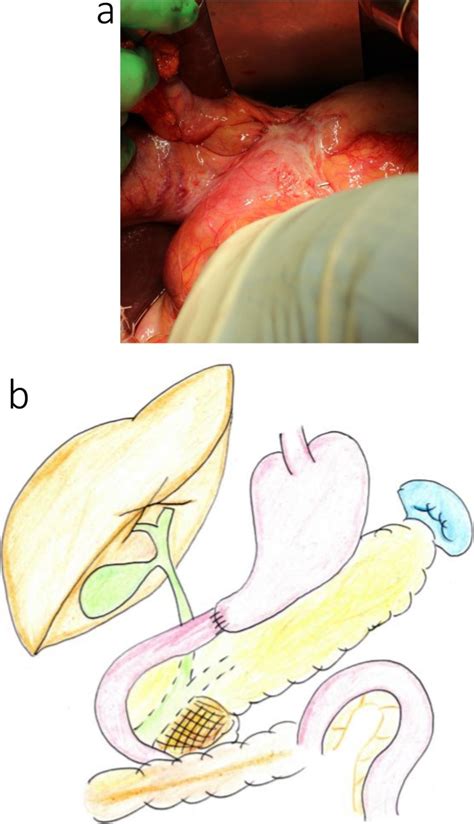 Pancreaticoduodenectomy After Distal Gastrectomy A Case Series