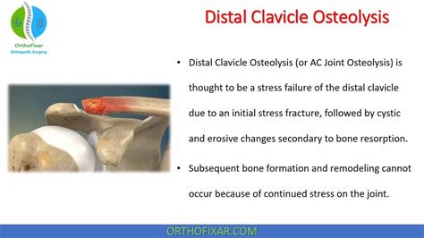 Distal Clavicle Osteolysis Orthofixar 2023