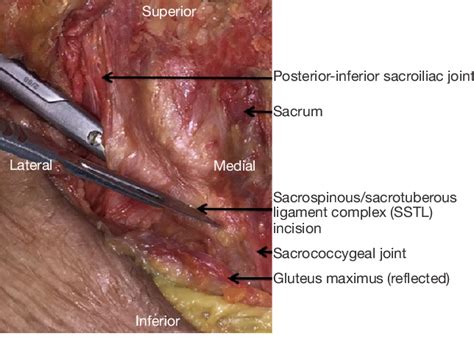 Figure From Identifying The Superior And Inferior Gluteal Arteries During A Sacrectomy Via A