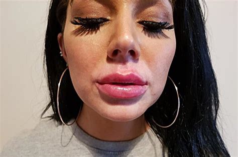 Lip Fillers Mum Grace Teal Looked Like Shed Done 10 Rounds With Mike
