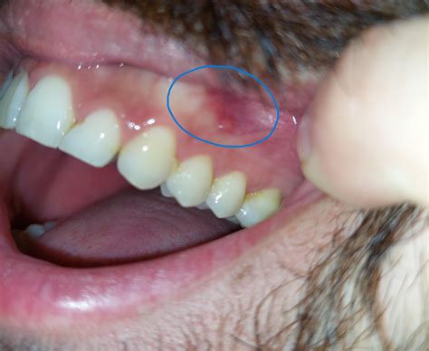 Redclear Ish Bump On My Gums It Reappears Ocassionally Its Not