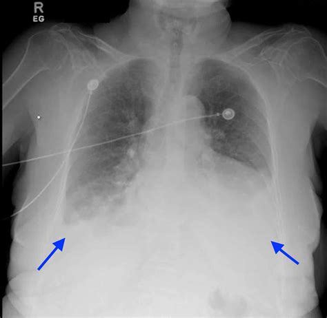 Chest X Ray Shows Complete Resolution Of Bilateral Pleural Effusion Images My Xxx Hot Girl