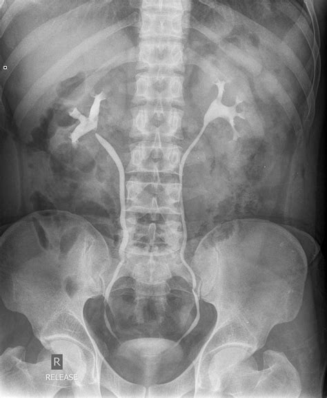 Normal Intravenous Urography Image