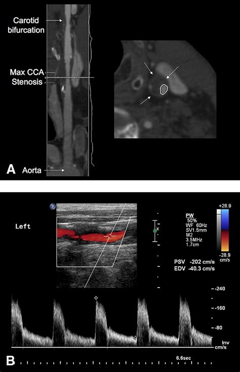 Detection Of Common Carotid Artery Stenosis Using Duplex
