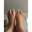 Muscle Atrophy In The Feet Is It Even Possible For To Appear 