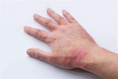 Atopic Eczema Right Hand 53 Year Old Photograph By Take 27 Ltd