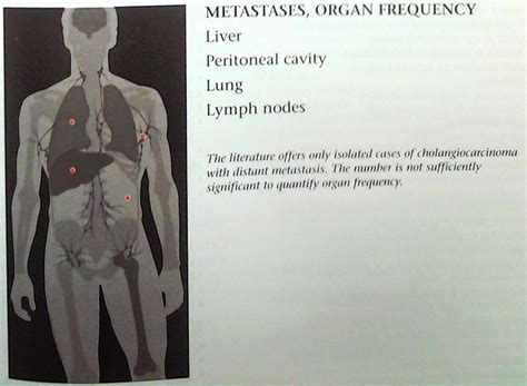 Winding Spiral Case Diagnostic Imaging Oncology Cancer Metastases