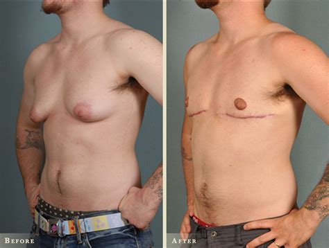 Male Breast Reduction Before And After Colorado Plastic Surgery