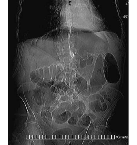 Plain Abdominal X Ray Shows Free Air Under The Diaphragm And Massive