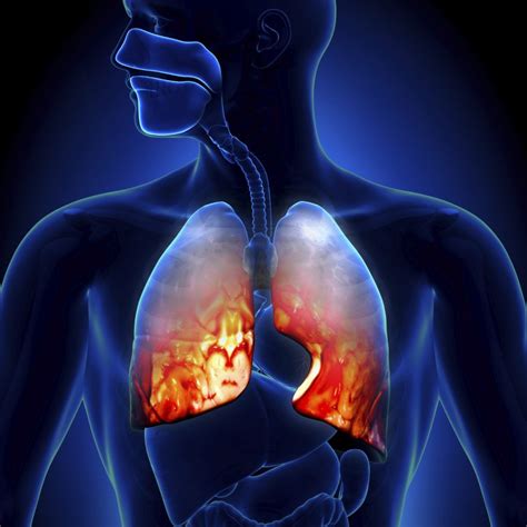 Bronquitis crónica Qué es síntomas causas tratamiento y más