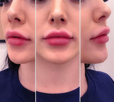 Yes Or No Lip Enhancement By Me Using Juvederm Xc Ultra 1 Syringe