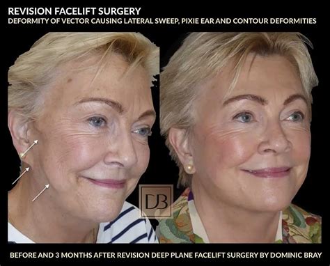 Revision Facelift Dr Dominic Bray
