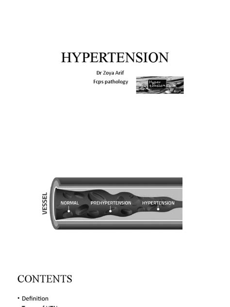 Hypertension Pdf
