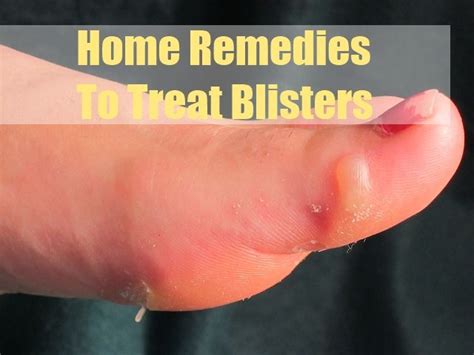 Best Home Remedies To Treat Blisters With Images Home Remedies