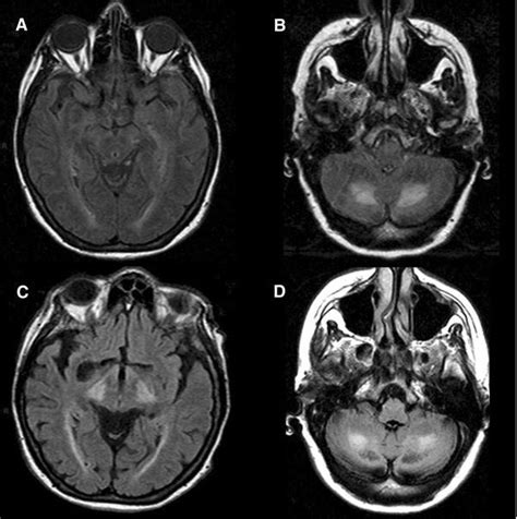 Brain Mri Findings In A “neurologically Worsening” Ctx Subject Patient