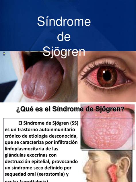Tema 7 2 Parcial 4 Sindrome De Sjogren Enfermedad Autoinmune Inmunología Prueba