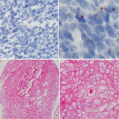 The P16 Immunohistochemistry Positive Case Showing Strong Nuclear And