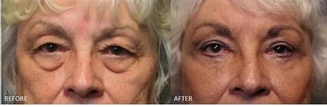 Lower Eyelid Surgery Recovery Cheaper Than Retail Price Buy Clothing Accessories And Lifestyle