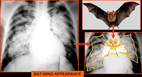 Bat Wing Appearance In Pulmonary Edema And Alveolar Proteinosis