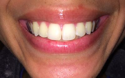 Invisalign for straight teeth without the fuss. Can I straighten my teeth without braces? Spring retainer ...