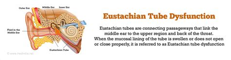 Eustachian Tube Dysfunction Causes Symptoms Diagnosis Treatment
