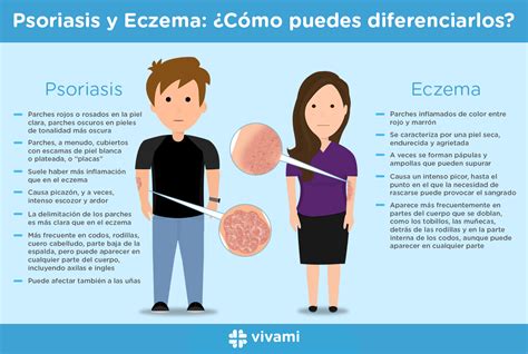 Psoriasis Y Eczema ¿cómo Puedes Diferenciarlos