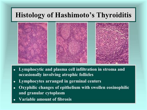 Hashimotos Thyroiditis Histology