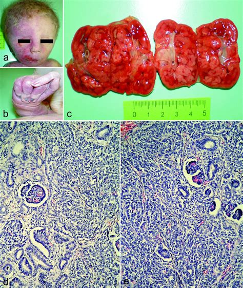 Bilateral Wilmstumor In Trisomy 18 Syndrome Case Report And Critical