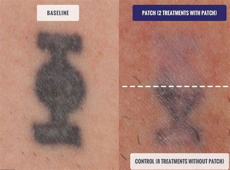 Accelerated Tattoo Removal Treatment Vanish Laser Clinic Alexandria Va