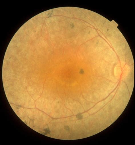 Cystoid Macular Edema Due To Retinitis Pigmentosa Retina Image Bank