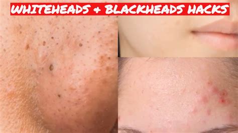 See What Happens To Your Whiteheads When You Do These 5 Things
