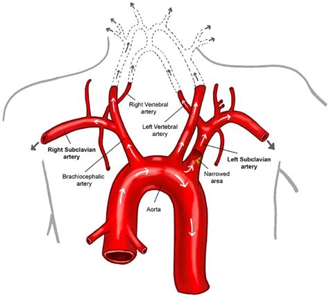 Vascular Disease Patient Information Page Subclavian Artery Stenosis