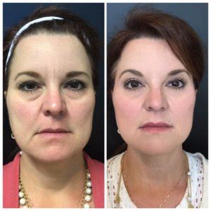 Naturally as you age it will start to have an affect on the mexico (méxico) +52. Achieving the Perfect Brow with Botox - Chattanooga Facial ...