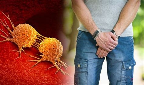 Prostate Cancer Symptoms Blood In Semen Could Be Sign Of The Deadly