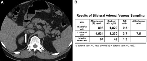 Role For Adrenal Venous Sampling In Primary Aldosteronism Surgery