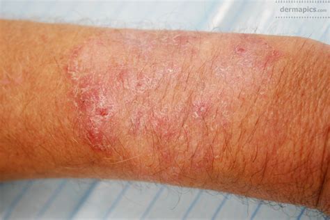 Fungal Infection Of The Skin Ringworm Pictures And Clinical Information