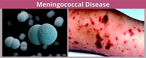 Meningococcal Disease Benton Franklin Health District
