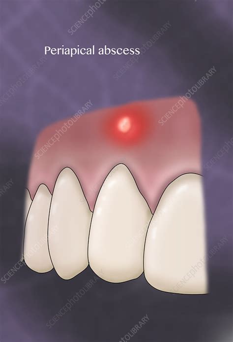 Periapical Abscess Illustration Stock Image C0366285 Science