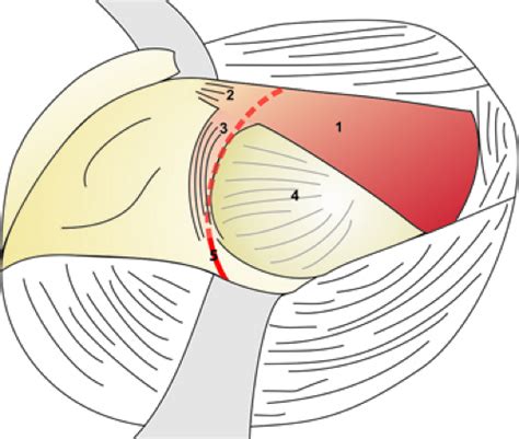 Chiari And Salvage Osteotomy For The Treatment Of Symptomatic