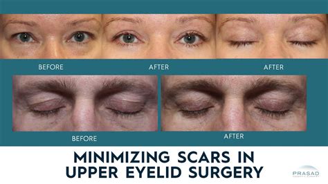 How Upper Blepharoplasty Scars Can Be Almost Imperceptible Youtube