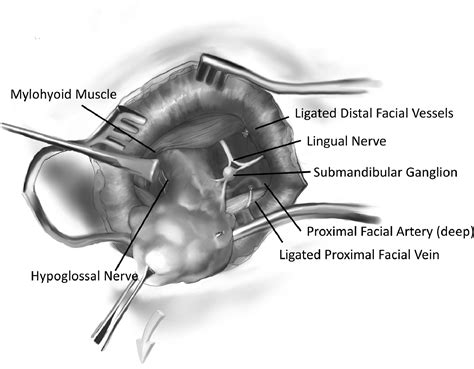 Surgical Excision Of The Submandibular Gland Operative Techniques In