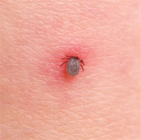 How To Treat A Tick Bite The Right Way According To Dermatologists In