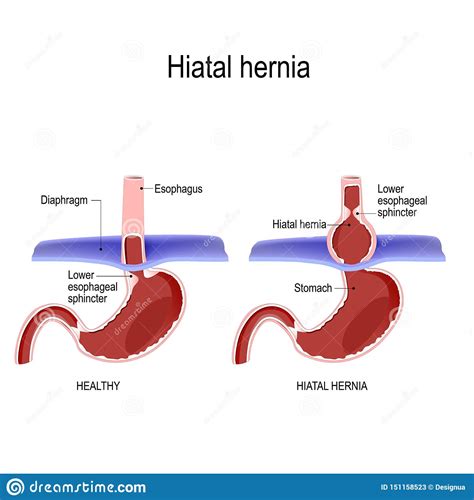 Hiatal Hernia Vector Diagram Of Normal Anatomy And Sliding Hiatal
